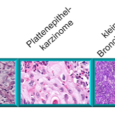 Verteilung von Histologien